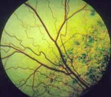 Prcd-PRA ist der Gentest für die progressive Retinaatrophie (PRA). PRA ist eine Augenkrankheit, bei der die Netzhaut des Hundes langsam abstirbt. Die Krankheit ist erblich und fortschreitend (progressiv) und führt letztendlich zur Erblindung beider Augen.