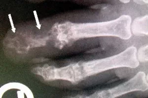Eine Osteomyelitis ist eine infektiöse Entzündung des Knochenmarks. Eine seltene Infektion, die unbedingt behandelt werden muss.