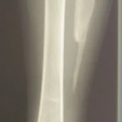 Osteomyelitis - DocCheck Flexikon