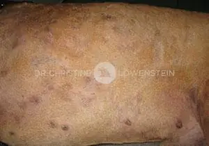 Pyodermie - Dr. Christine Löwenstein